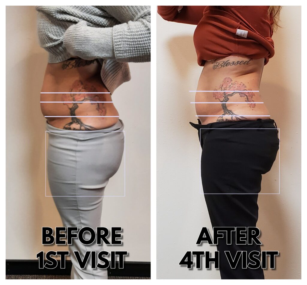 Body Contour Before And After Photos HBOT Cryo Wellness Center