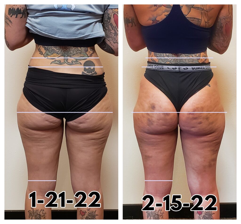 Body Contour Before And After Photos HBOT Cryo Wellness Center