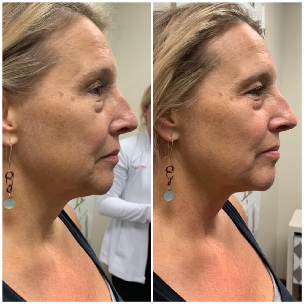 Beauty Before And After Photos Hbot Cryo Wellness Center