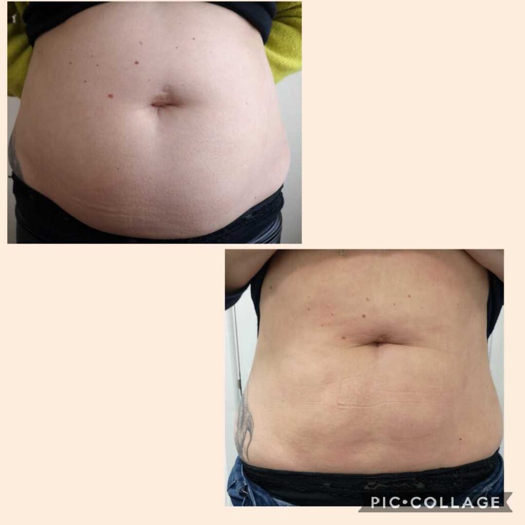 Body Contour Before And After Photos Hbot Cryo Wellness Center 9945