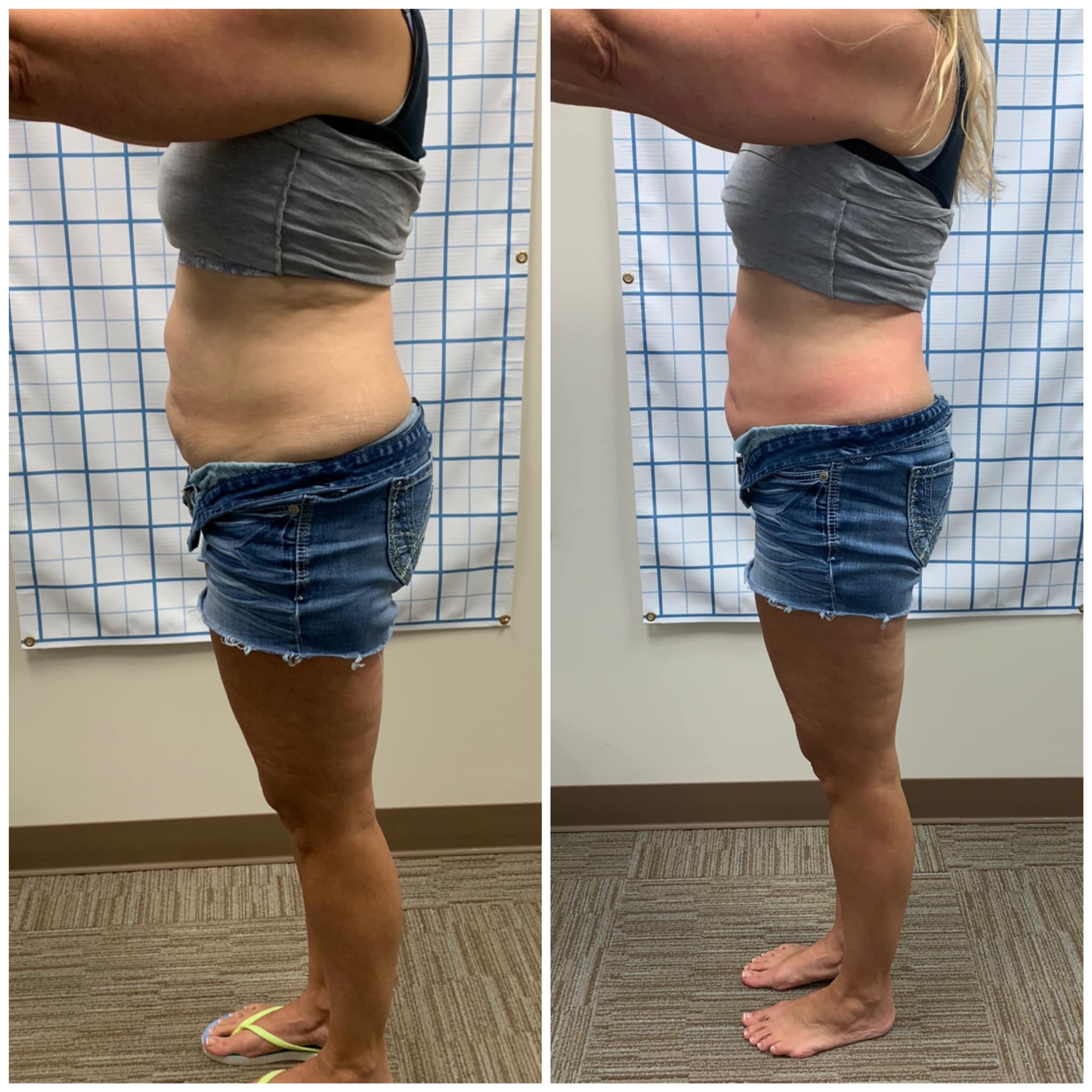 body-contour-before-and-after-photos-hbot-cryo-wellness-center
