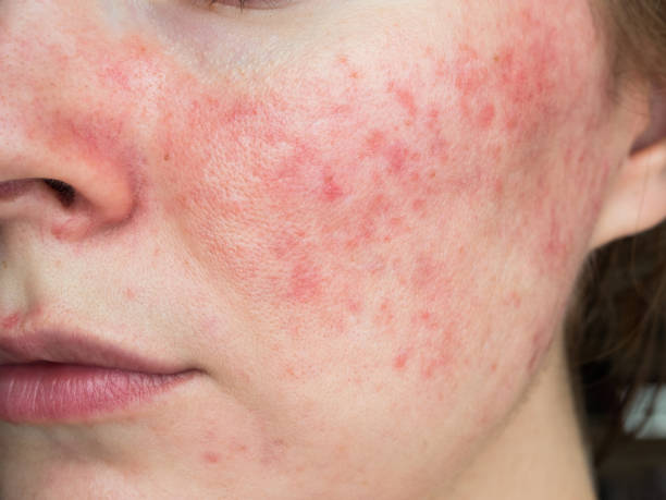 psoriasis, eczema, and rosacea, Boise, ID Idaho